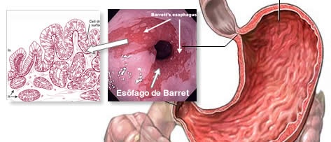 Med Clinic São Lucas - A úlcera gástrica é uma ferida no estômago